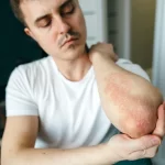Psoriasa në trup: Çfarë e shkakton dhe si ta kuroni atë