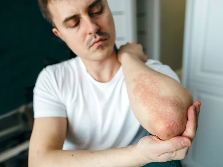 Psoriasa në trup: Çfarë e shkakton dhe si ta kuroni atë